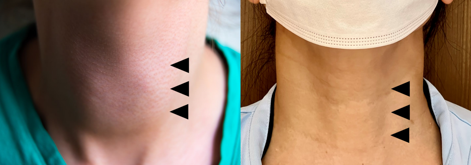 甲状腺がんの合併症